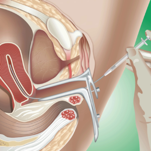 Imagem ilustrativa de uma mão realizando a inseminação intrauterina em uma mulher.