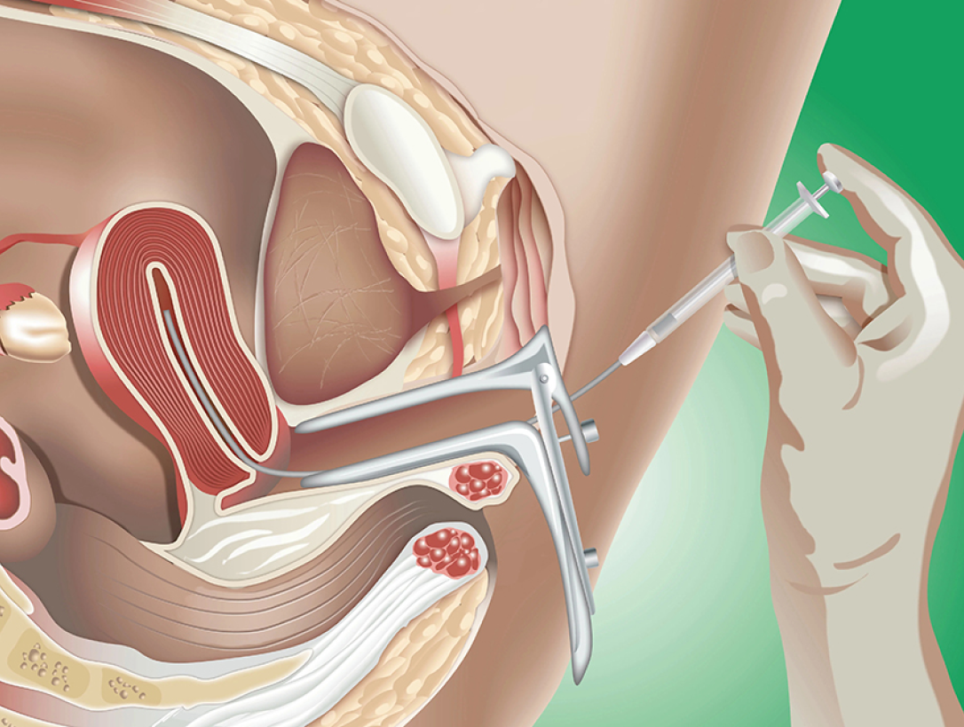 Imagem ilustrativa de uma mão realizando a inseminação intrauterina em uma mulher.
