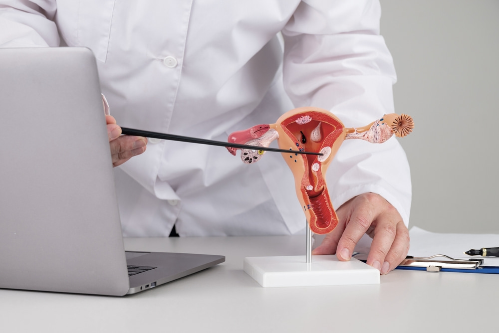 Médico com modelo do sistema reprodutivo feminino apontando anomalias existentes, possivelmente endometriose.